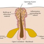 comedone_open1