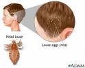 head-lice