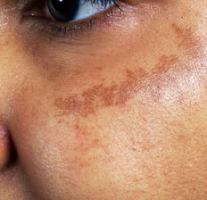 Brown Spots on Face and Body