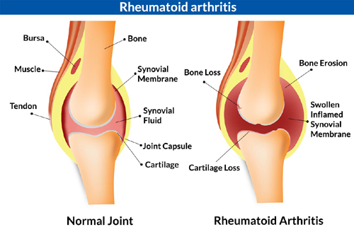 Foods that Help Joint Pain and Inflammation
