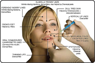 botox injections