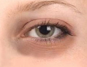 Remedies for Dark Circles