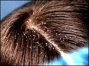 Best Homemade Mask for Hair Dandruff