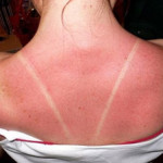 Homemade Tips to Get Rid of Suntan