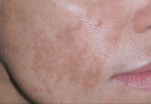 Brown Spots on Face and Body