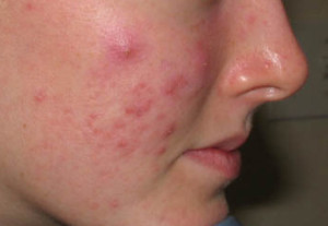 Get rid of acne scars