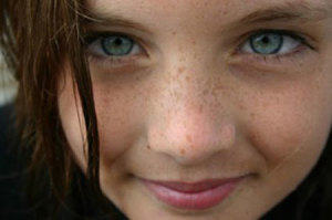 Best Treatment and Diet for Freckles by Dr Khurram