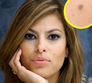 Treatment to Get Rid of Moles