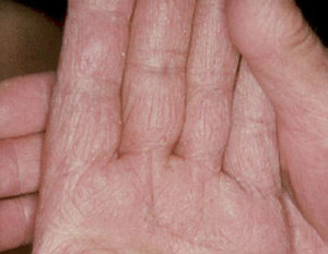 fungal infection on hands treatment