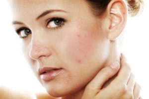 Homemade Acne Soap and Cleanser