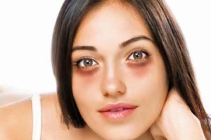 dark circles