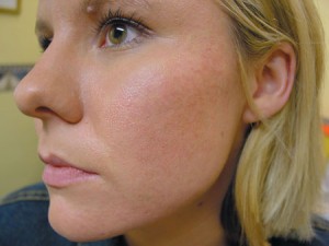 Acne Scars Cream