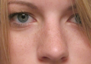 freckles on nose