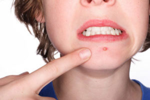 Tips for Glowing Skin and Pimples