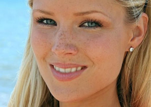 remedy for freckles