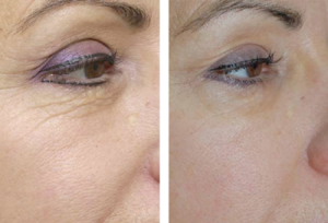 Micro Fractional Ablative