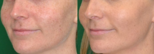 MicroLaserPeel