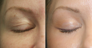 Ultrapulsed Fractional CO2