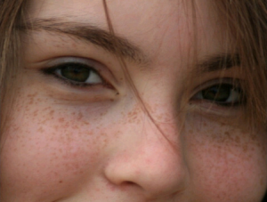 freckles treatment