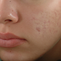 How to Remove Acne Scars with Laser Treatments