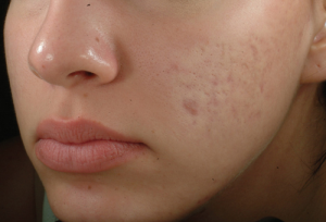 laser treatment face