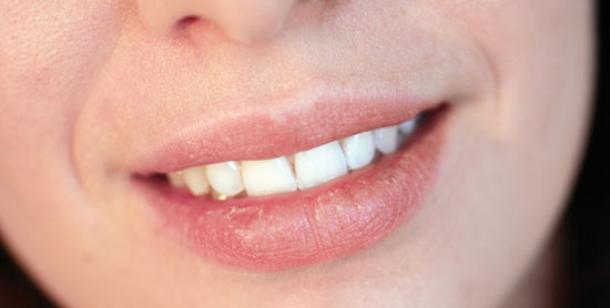 Cracked Lips: How to Avoid them?