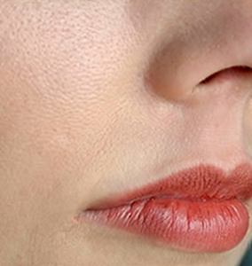 Skin Treatment for Large Pores