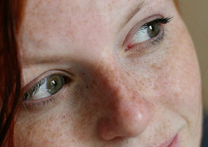 Facial Treatment for Freckles