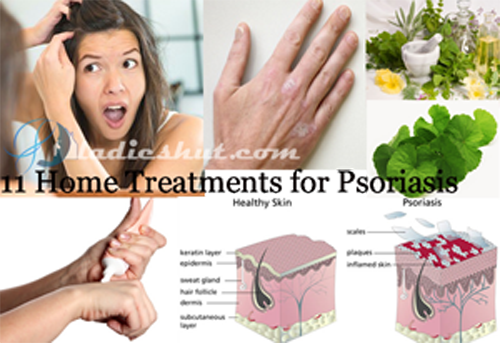 Home Treatments for Psoriasis