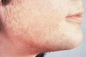 Unwanted Facial Hair Removal