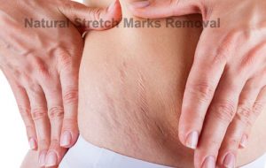Natural Stretch Marks Removal