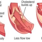 Lower High Cholesterol 1