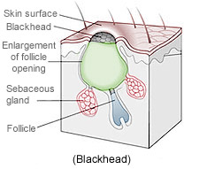 blackheads21